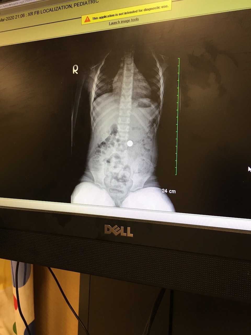 x-ray of my daughter Maddie's belly from when Maddie swallowed a steel ball from a magnet toy set